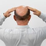 Hair Loss in Men